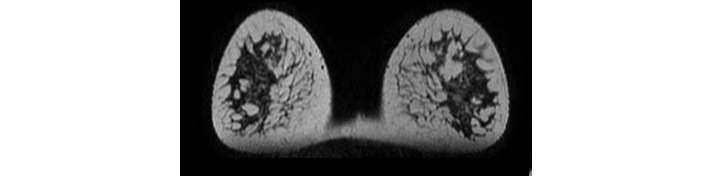 3D T2w VISTA (MPR) - Breast