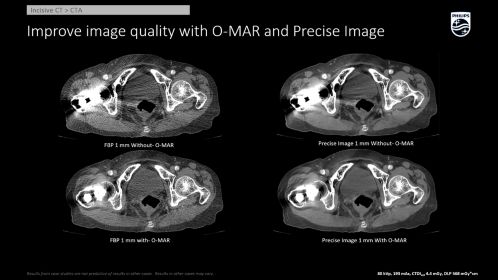 Incisive CT Precise Image CTA - WO and W OMAR CTA