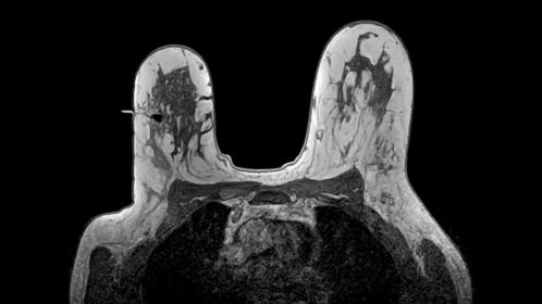 Axial 3D T1w FFE Post-biopsy check, clip inserted
