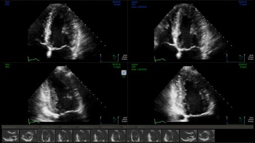 Ultrasound Workspace Stress Echo
