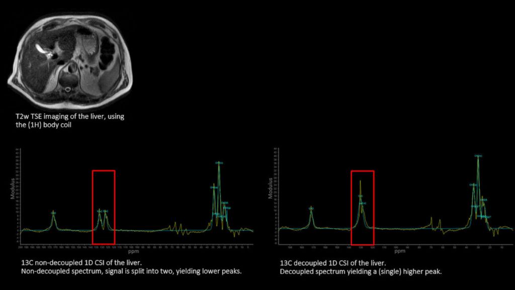 C140 Liver 1D CSI (comparison)