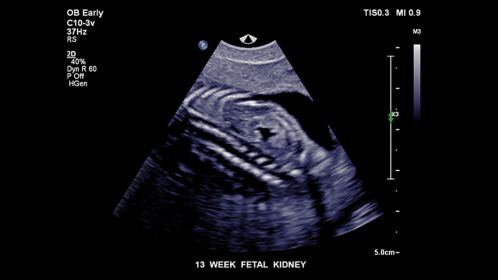13 week fetal kidney
