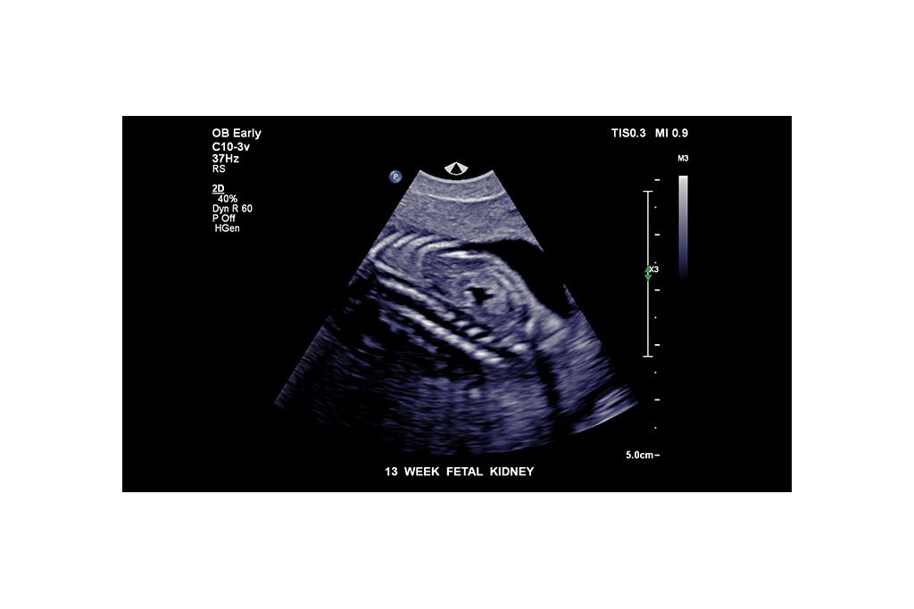 13 week fetal kidney
