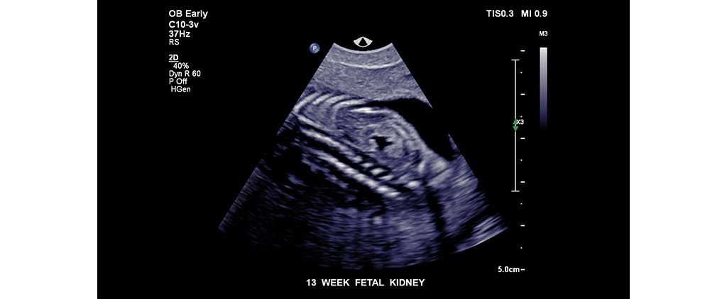 13 week fetal kidney
