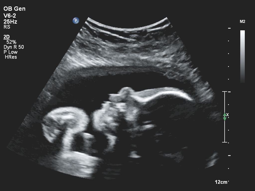 Affiniti 30 ultrasound clinical image obstetric fetal