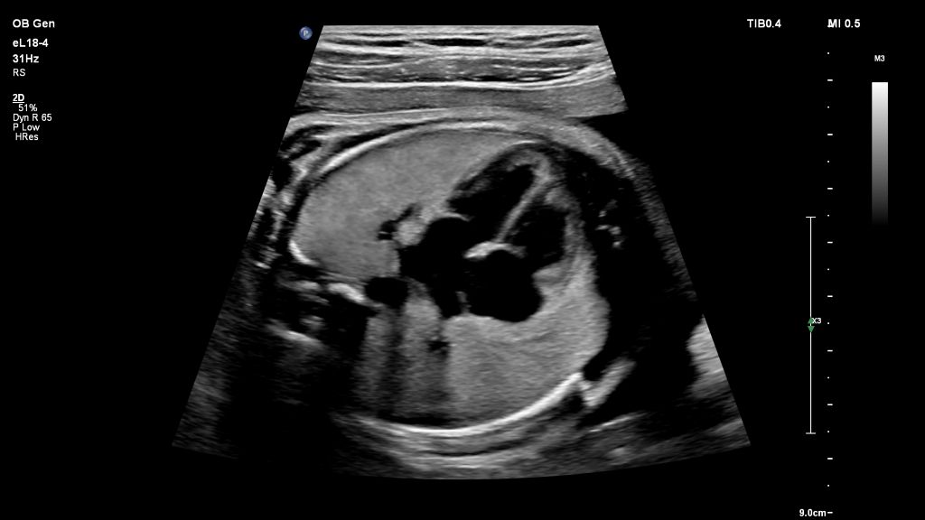 Fetal Heart- eL18-4 Trapezoid