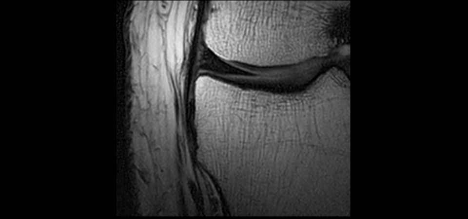 Coronal PDw TSE – Knee