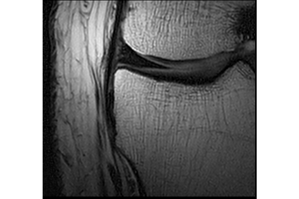Coronal PDw TSE – Knee