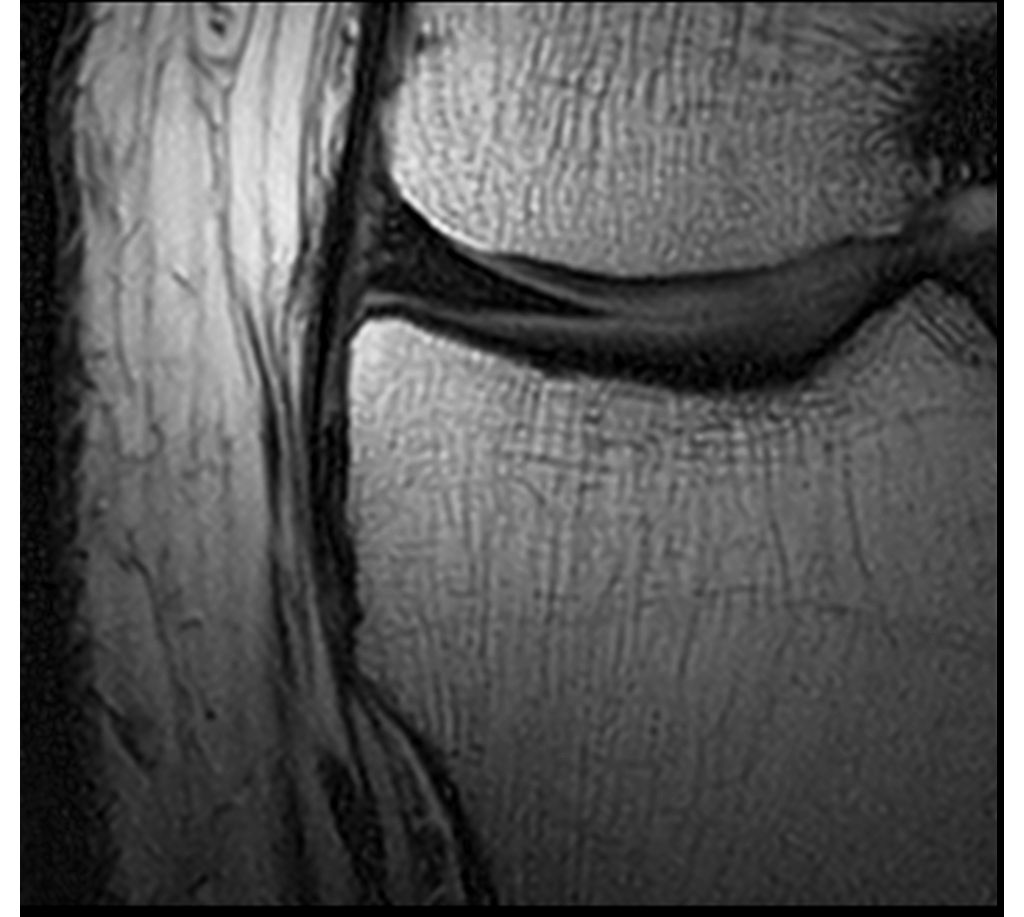 Coronal PDw TSE – Knee