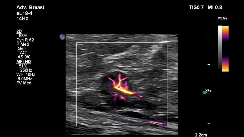 Clinical image using EPIQ Elite and eL18-4 transducer to show breast lymph node axilla using MFI HD 
