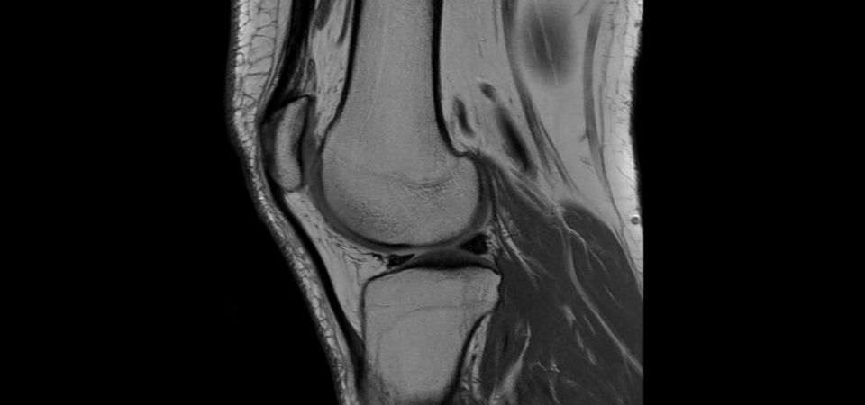 Sagittal PDw TSE