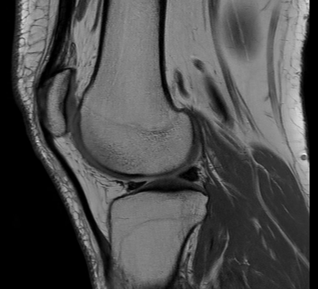 Sagittal PDw TSE
