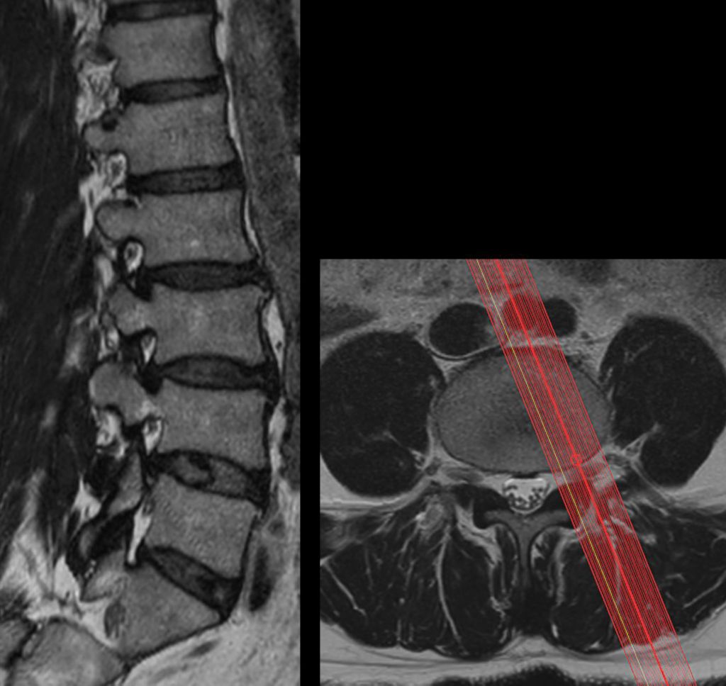 Sagittal 3D SpineVIEW T2w TSE - Oblique Reformats