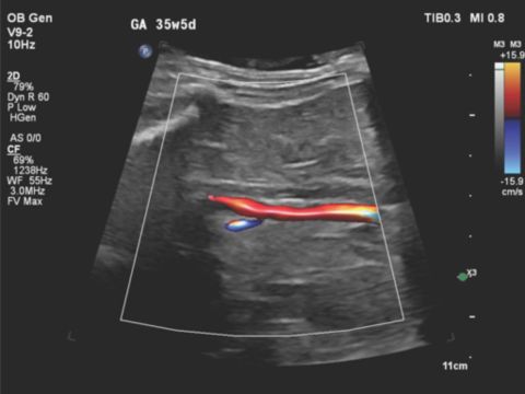 V9-2 transducer coronal image of the fetal aorta and absence of bilateral renal arteries using color Doppler with Flow Viewer