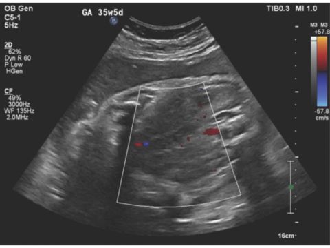 C5-1 transducer coronal image of the fetal aorta and absence of renal arteries using traditional color Doppler