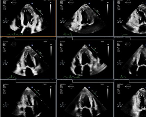 Echo Seamless screen capture Strain, EF, AI software application