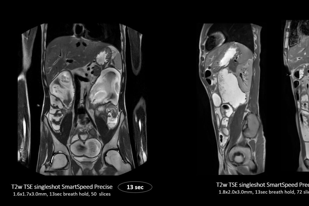 SmartSpeed Precise - Up to 3 times faster imaging. Preserve details in shorter scan times. Powered by Dual AI. 
Compared to Philips SENSE imaging. Dual AI: Reconstruction technology consisting of a first AI engine applied at the source of signal (Adaptive CS-NET) and a second AI engine applied on the raw complex imaging data (Precise Image Net).


