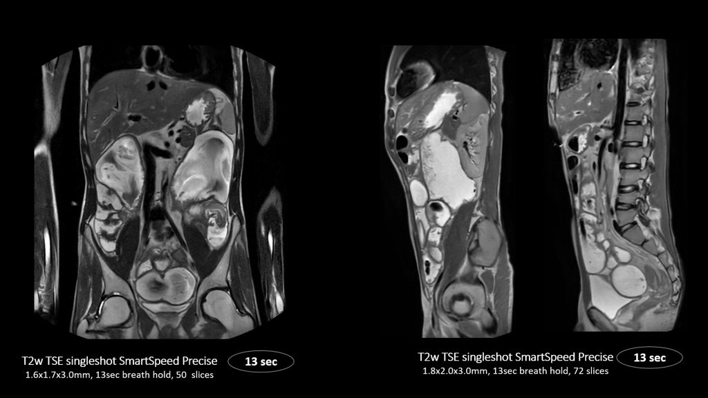 SmartSpeed Precise - Up to 3 times faster imaging. Preserve details in shorter scan times. Powered by Dual AI. 
Compared to Philips SENSE imaging. Dual AI: Reconstruction technology consisting of a first AI engine applied at the source of signal (Adaptive CS-NET) and a second AI engine applied on the raw complex imaging data (Precise Image Net).

