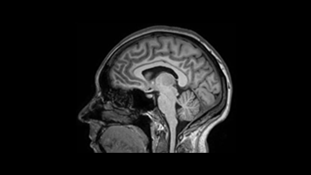 3D T1w TFE clinical image of the brain