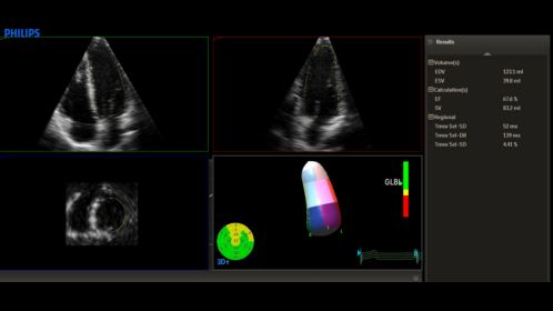 Ultrasound Workspace 3D Quantification Advanced