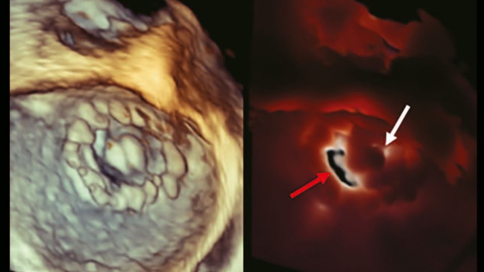 TrueVue - Transillumination aids in identifying an obstructive mitral valve prosthesis.