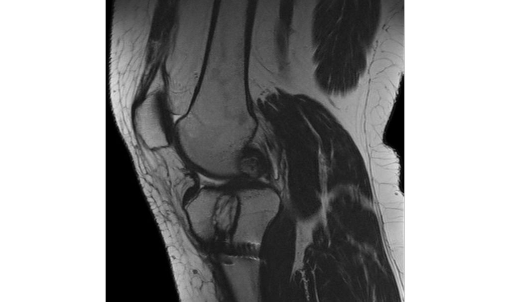Sagittal T2w TSE (MARS)