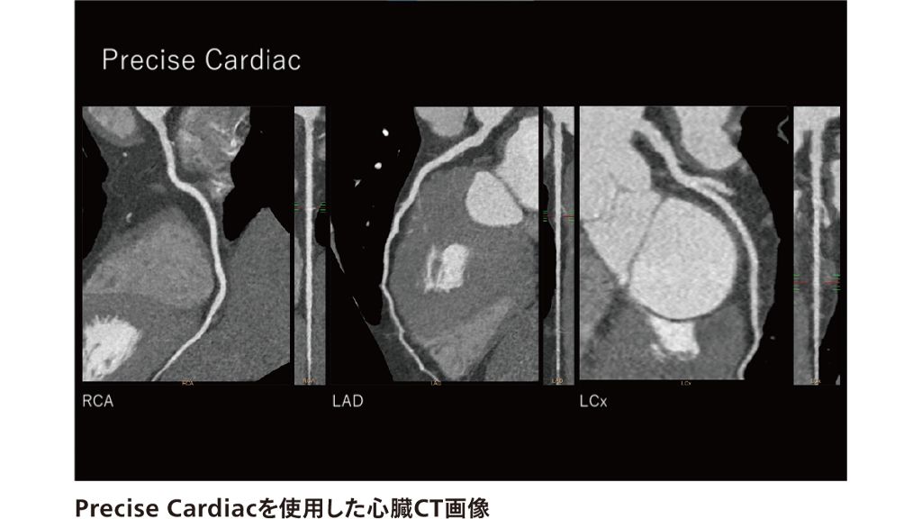 Precise Cardiacを使用した心臓CT画像
