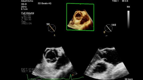 Live 3D TEE shown with X8-2t