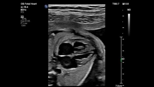 Fetal Heart- eL18-4