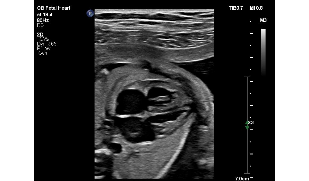Fetal Heart- eL18-4