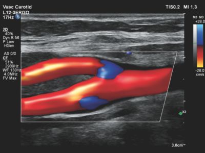 Farbduplexsonographie hirnversorgender Arterien - EXPERTENKURS
