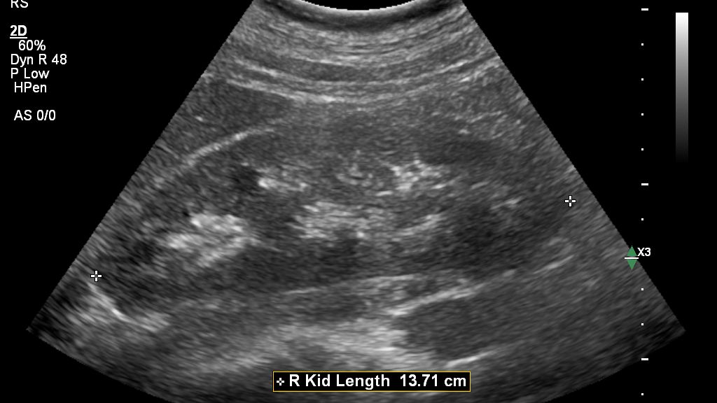 Auto Measure Abdomen Right Kidney Length