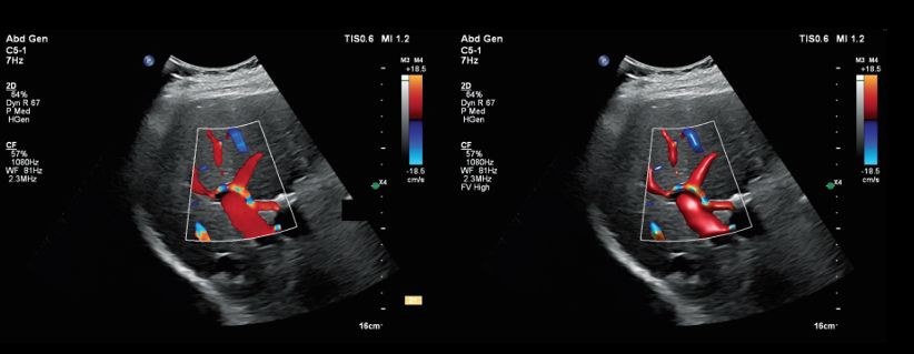 Color Doppler image of the portal vein and hepatic artery. Right: Flow Viewer version of the image on the left (applied in post-processing). 