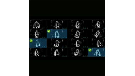 AutoStrain LV with automated EF and mid-layer strain
