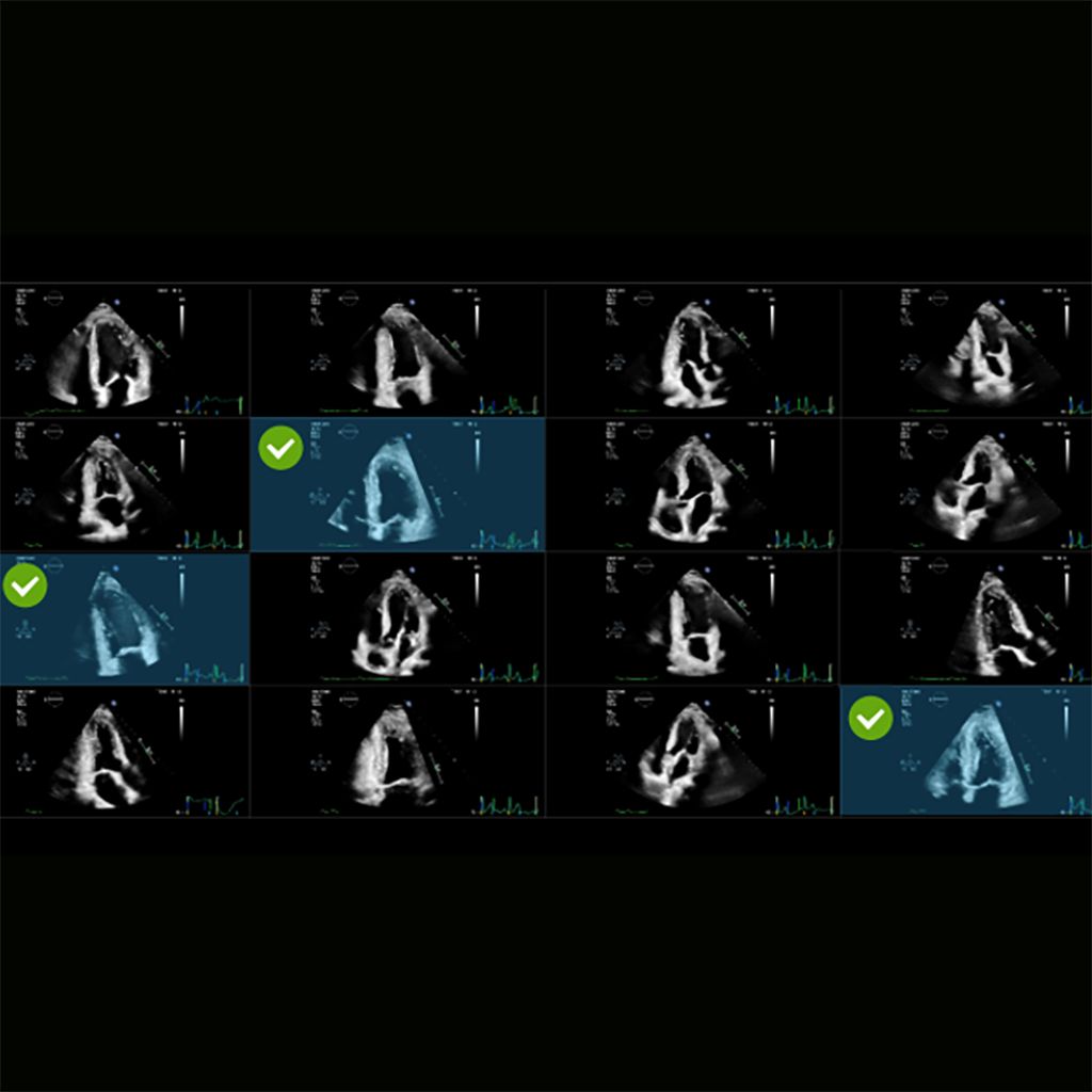 AutoStrain LV with automated EF and mid-layer strain