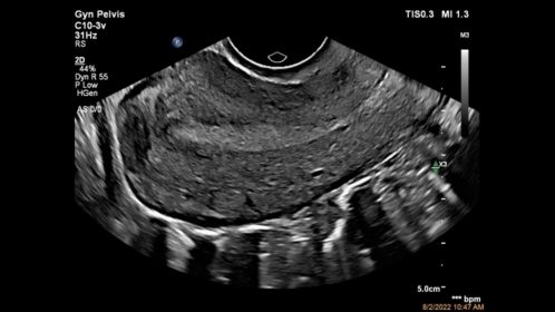 Sagittal image of the uterus shown using a C10-3v transducer
