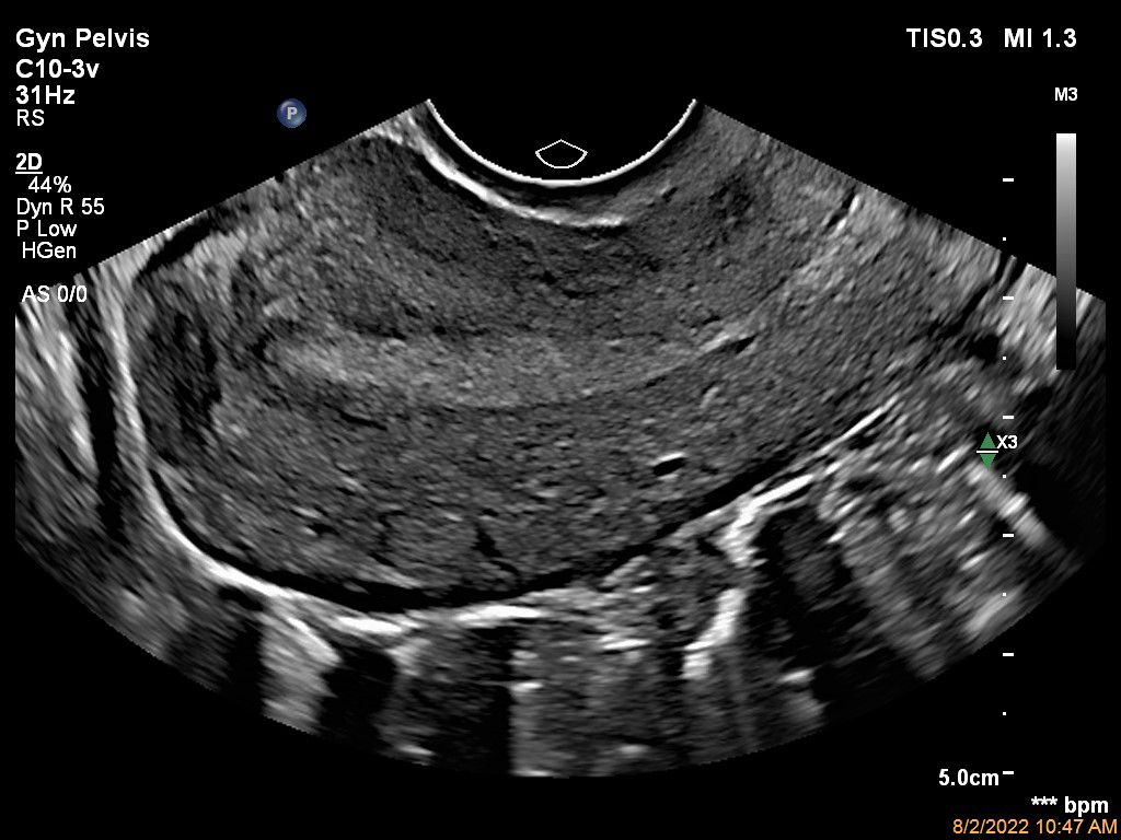 Sagittal image of the uterus shown using a C10-3v transducer