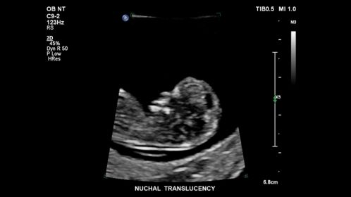Nuchal translucency