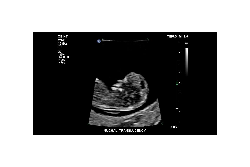 Nuchal translucency