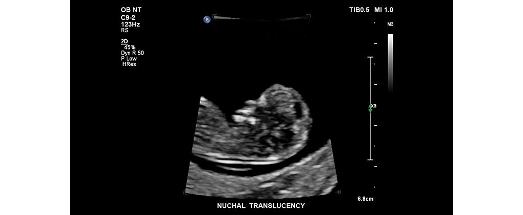 Nuchal translucency