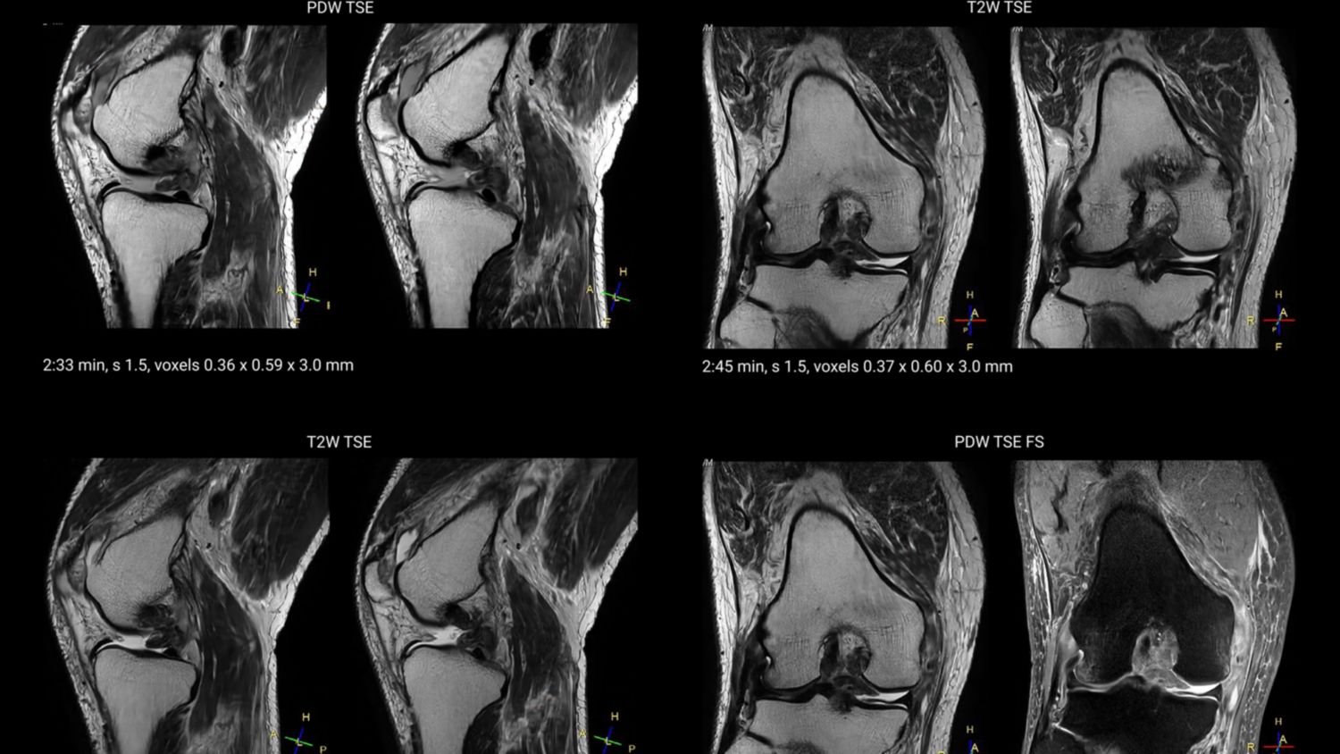Knee MRI showing a PCL tear, detached MCL and intact ACL