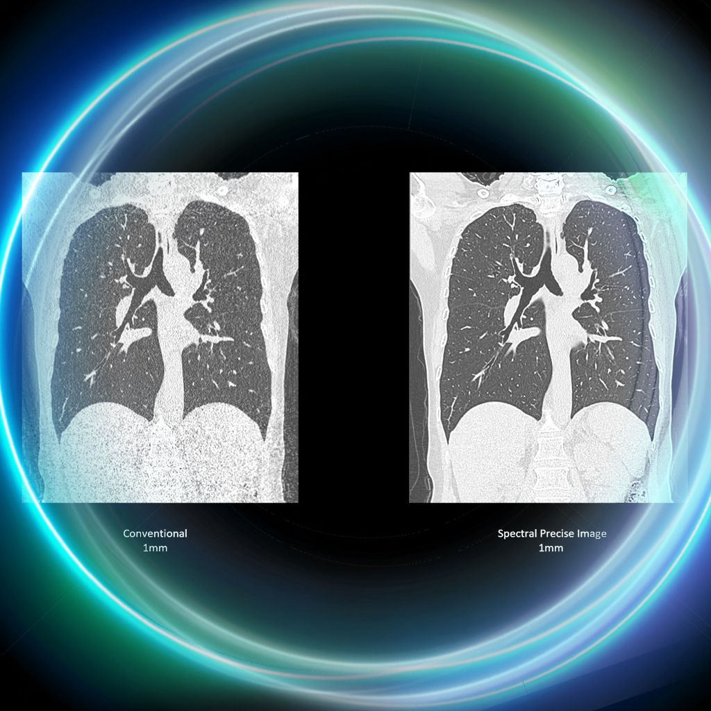 See higher image quality with Spectral Precise Image
