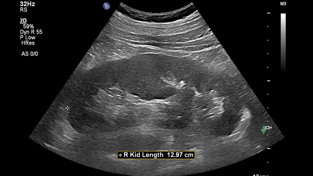 Clinical image using EPIQ Elite and C5-1 transducer showing abdominal right kidney length using Auto Measure Abdomen 