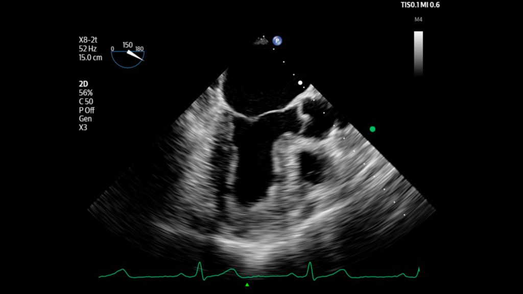 Left ventricle with views of the Mitral and Aortic valves shown with X8-2t transducer.