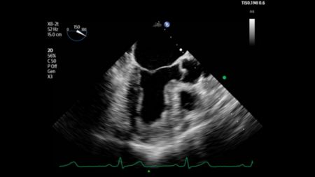 Left ventricle with views of the Mitral and Aortic valves shown with X8-2t transducer.