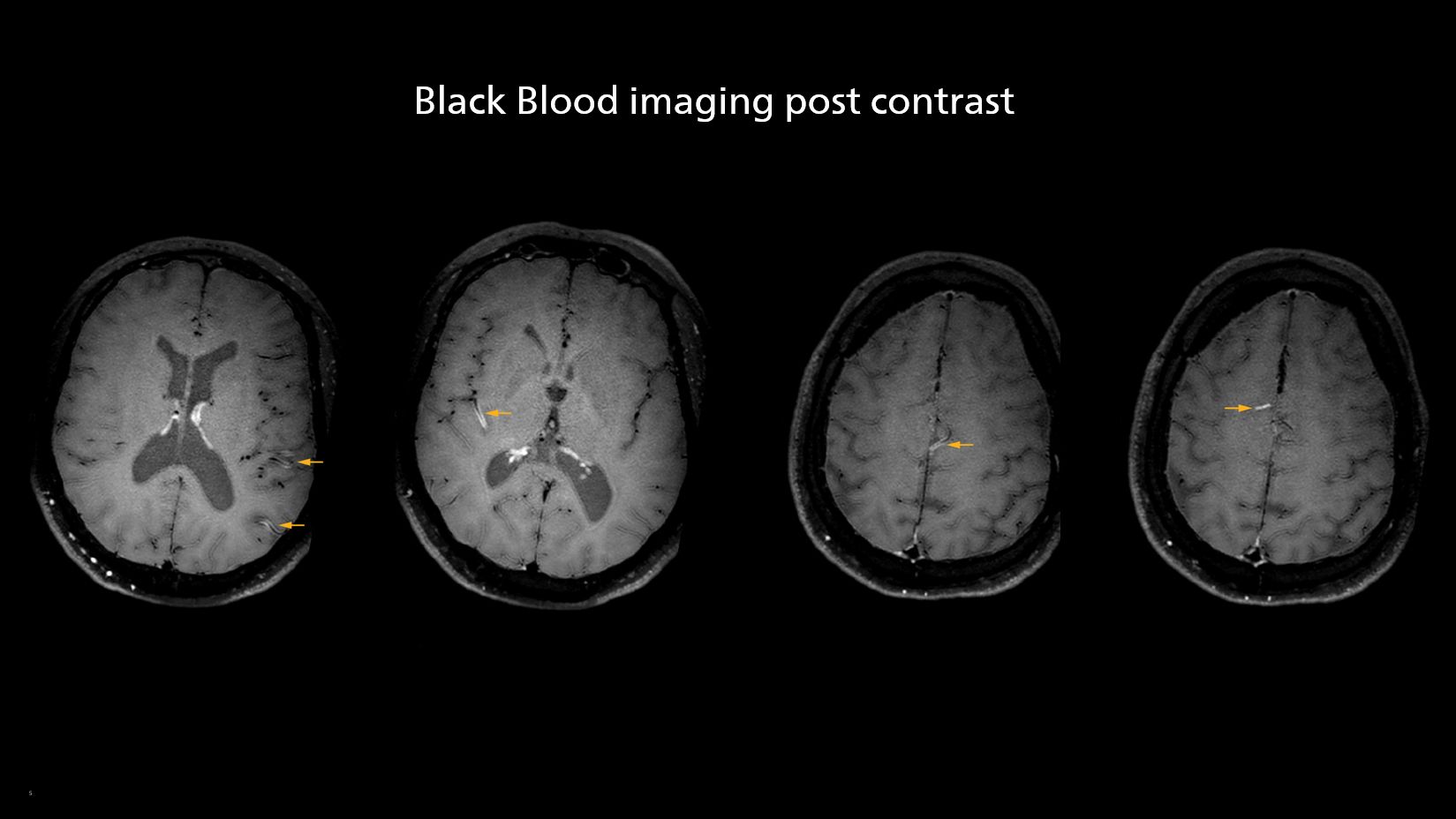Black Blood imaging post contrast