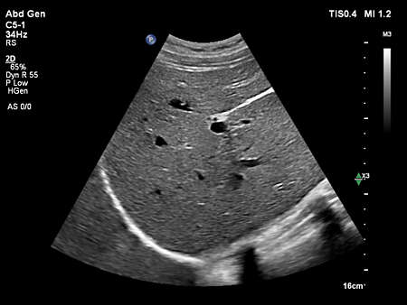C5-1 Abdomen Liver
