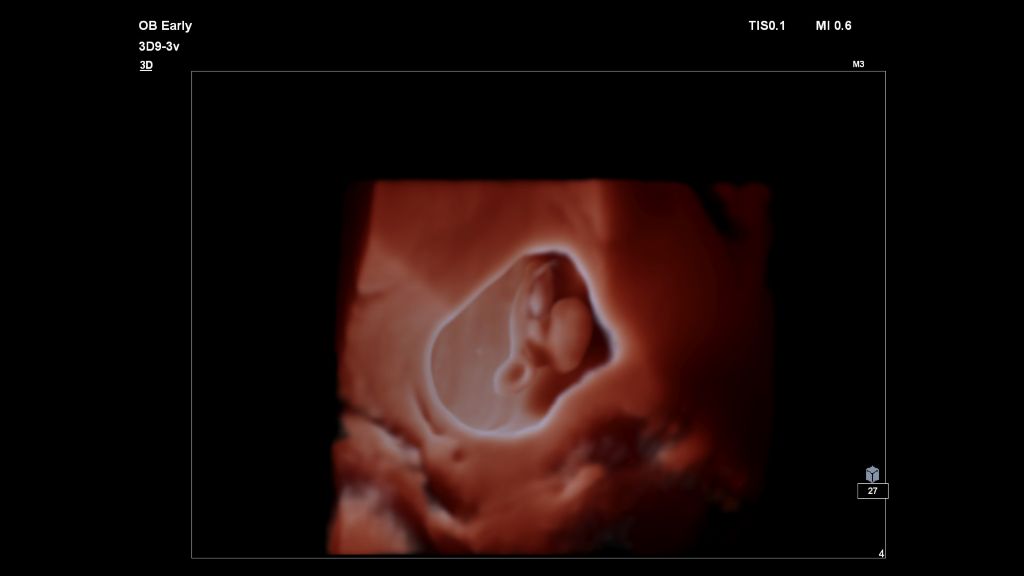 Ovaries shown with Color Power Angio using 3D9-3v transducer