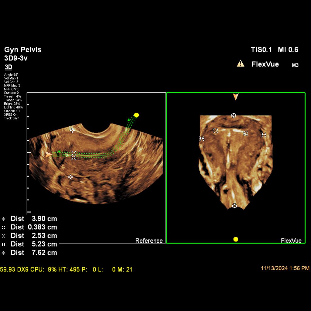 3D FlexVue ultrasound image with measurements