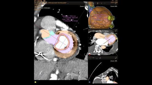 Mitral Valve Replacement procedure planning